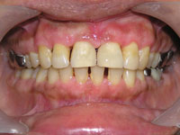 Diastema / Spacing Beth Teeth