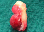 cysts treated