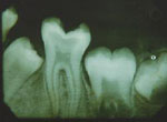 Root Canal Therapy