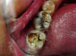 dental decay