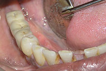 Single Tooth Implant