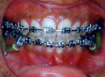 kinds of braces