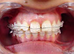 kinds of braces