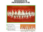 moderate Periodontitis