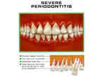 bevere periodonitis